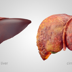 Hepatitis