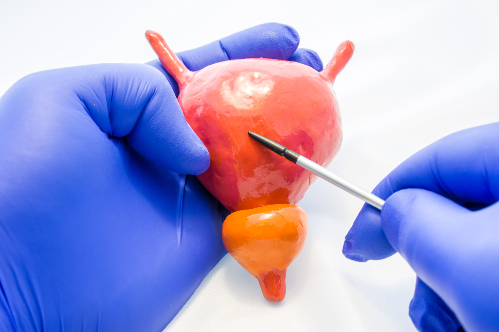 Cancer Bladder
