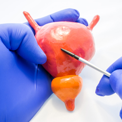Cancer Bladder