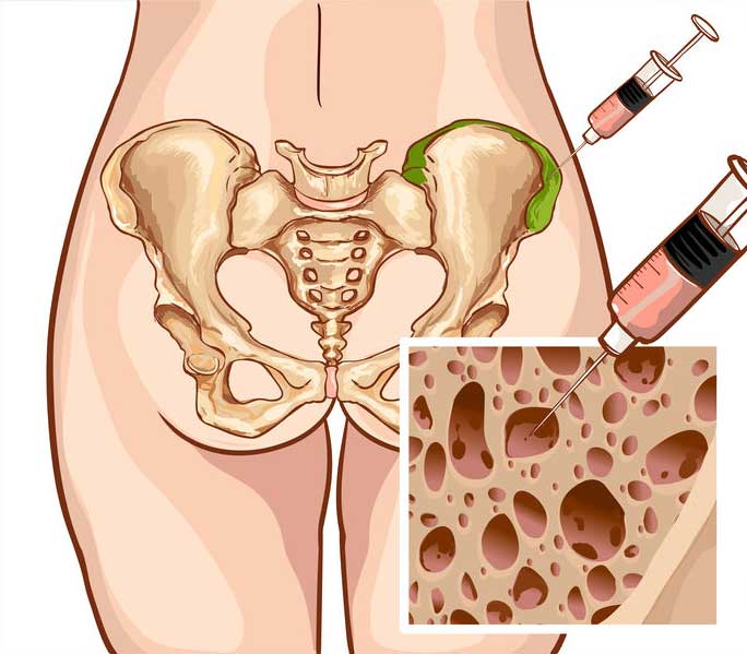 Bone marrow obtaining