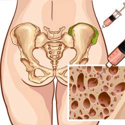 Bone marrow obtaining
