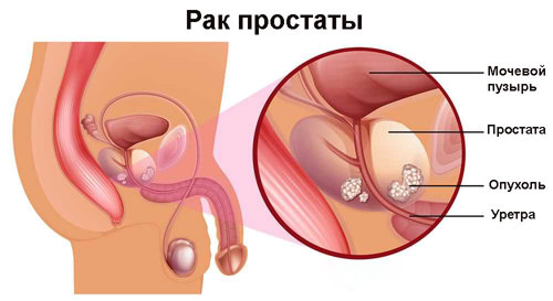Лечение рака простаты за границей