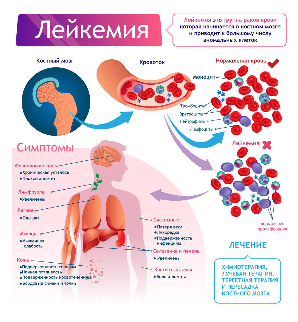 Симптомы и лечение лейкоза (лейкемии) за границей