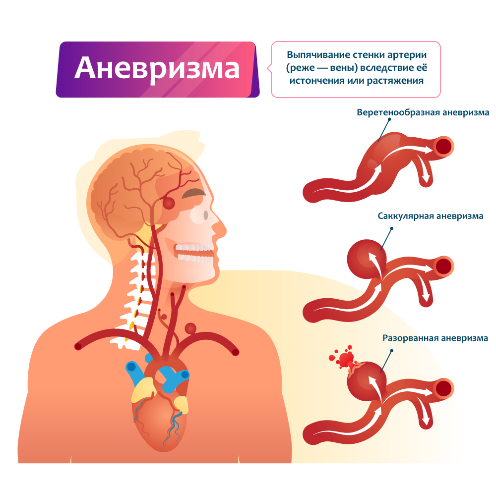 Лечение аневризмы в Турции, Германии, Израиле