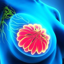 Breast Tumor