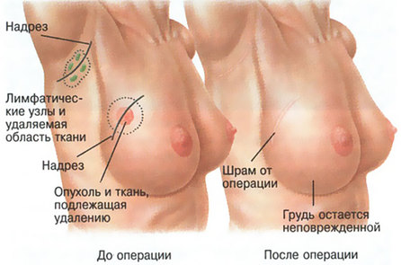 Органосохраняющая операция при раке груди