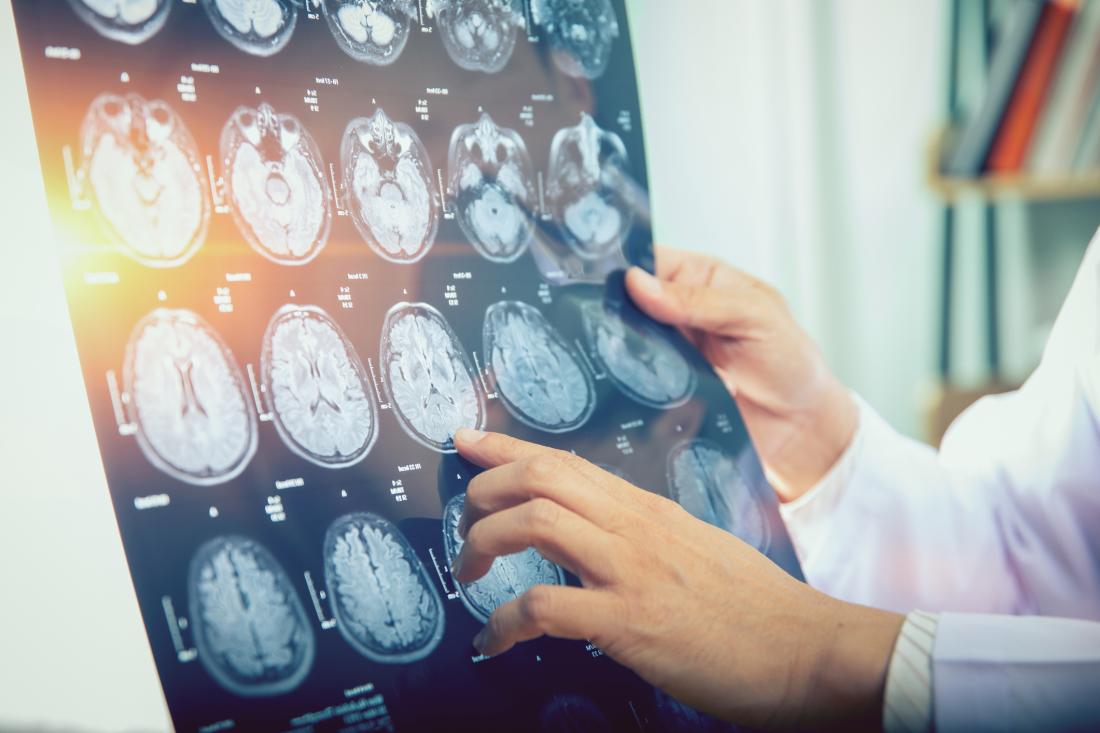 Epilepsy Neurology