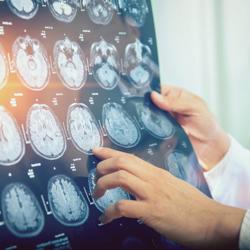 Epilepsy Neurology